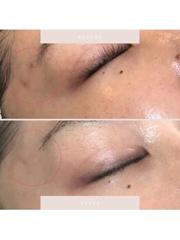 ブリス(Bliss)/リアボーテハーブトリートメント