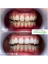 ホワイトニングサロン 名古屋駅店/【ホワイトニング施術例】
