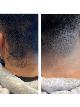 ラナンス 千早(LANUNCE)/うなじ脱毛