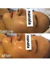 ナナラ(nanala)/韓国水光肌フルコースエステ