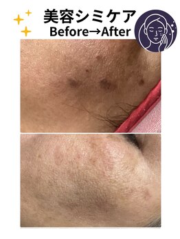 ヒカリ(Hikari)/しみケア1回目後