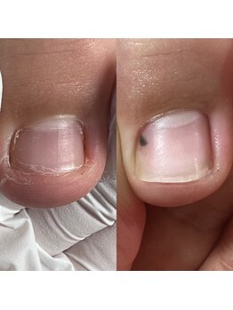 ルーチェ バイ フェリシア(LUCE by Felicia)/足爪ケア/深爪・むしり癖改善