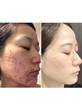 ディオネ/真皮育成　光糸リフト