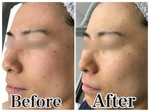 ルリアン(LeLien)/ダクトピール＋LDM 3回の効果！