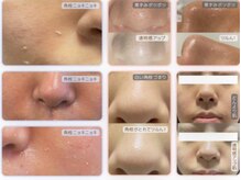 ミラトータルビューティ(Mira Total beauty)/ツルツル毛穴レス☆