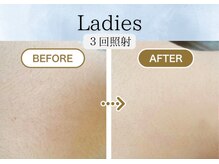 リベル(rebelle)/うなじ脱毛