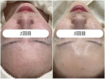 リンフェイス 銀座店(RIN FACE)
