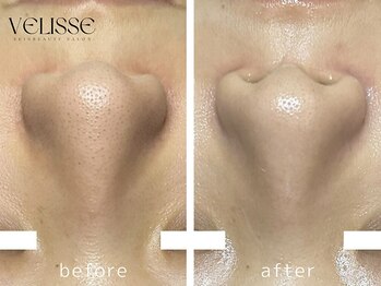 ヴェリス 福岡店(Velisse)/毛穴ケア