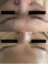 ミルキー(Milky)/スノーピールで手軽に肌美人