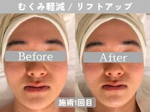 ミピマム 町田店/20代からの小顔ケア