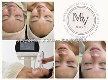 マヴィ 香里園店(MavY.)/瞬間リフトアップ☆水光注入