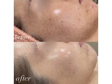 ジャストミービューティー(Just Me Beauty)/REVIハーブ　before after