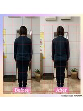 カイロプラクティック コダマ(KODAMA)/ビフォーアフター