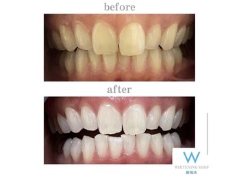 ホワイトニングショップ 新潟店/ホワイトニングビフォーアフター