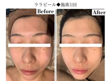 フレイヤ(FREYA)/ララピールBefore→After