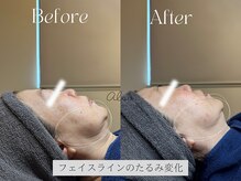 アイシス(AIsis)/【LDM/50代】たるみ/ハリ/弾力