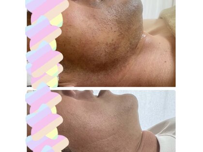 脱毛サロン ティアレ(Tiare)の写真