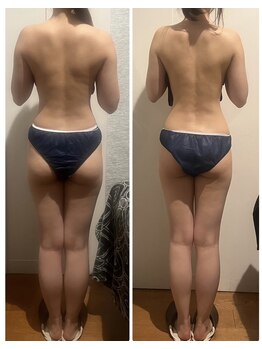 バンブー B2 新涯店(Bamboo)/人気No.1キャビリンパ1回施術