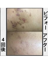 キッカ 梅田天六(Kikka)/ボディ　肌質改善