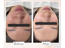 マーレ(MARE)の雰囲気（おすすめの【ララピール＋ハイドラNEO】の施術前後比較です。）