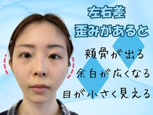 ナチュラルパーフェクトフェイス 新宿/頬骨の開き左右差/新宿小顔矯正