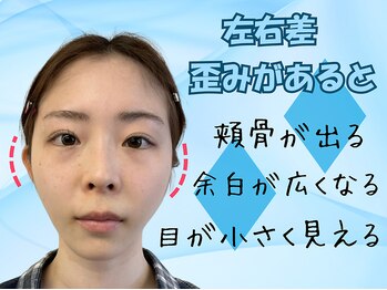 ナチュラルパーフェクトフェイス 新宿/頬骨の開き左右差/新宿小顔矯正