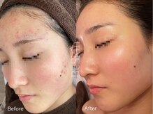 ビースキン 藤沢店(BeSkin)/おでこのぷつぷつ/ニキビ/跡ケア