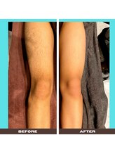 トリニティスペース(TrinitySpace)/ミックス脱毛