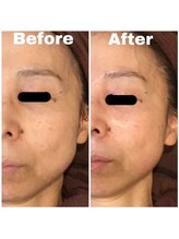 トータルビューティサロン エクスト(EXT)/純粋レチノールピール☆1回