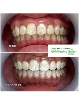 ホワイトニングサロン 名古屋駅店/【ホワイトニング施術例】