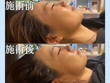 リブ(LIB)/毛穴洗浄ウォーターピーリング6