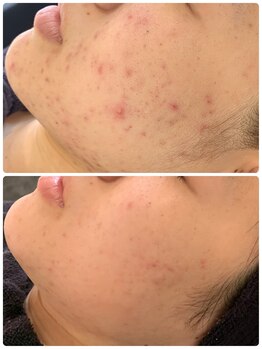 ビーエスアクアビューティー/ハイドラ＋ハーバルピーリング