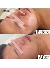 ロミエール 南草津店(LOMIERE)/セルマン★ニキビお悩みの方へ