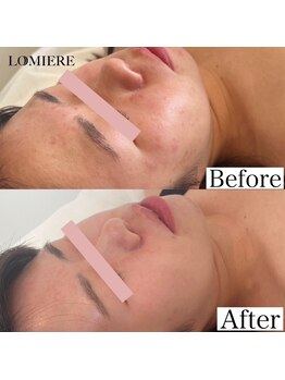 ロミエール 南草津店(LOMIERE)/セルマン★ニキビお悩みの方へ