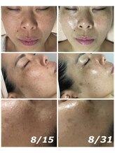 クリスタルボウ(Crystal BEAU)/Elight顔脱毛2回