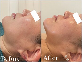 サロンドフェイス(Salon de Faith)/ハーブピーリング