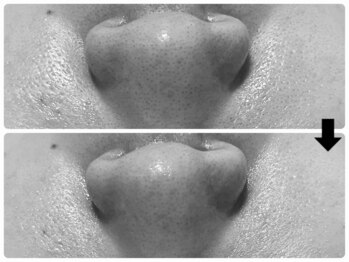 エフェクト 塚口店(effect)/Before After 40代/1回目