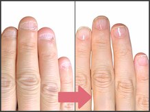 アモ 坂戸(’Amo)/深爪矯正・自爪育成 坂戸/北坂戸