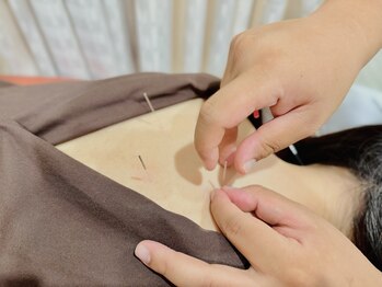 もりわき鍼灸整骨院 高槻市駅前院/鍼施術初めての方でも♪