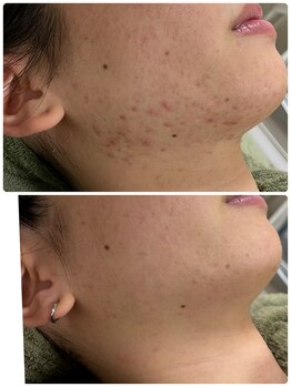 イネスプライベートスペース(Ines)/何をやっても変わらない肌荒れ