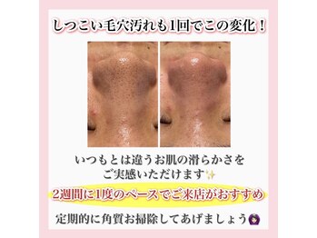 ホワイトアクア 梅田本店(WHITE AQUA)/ハーブピーリング/大阪/梅田