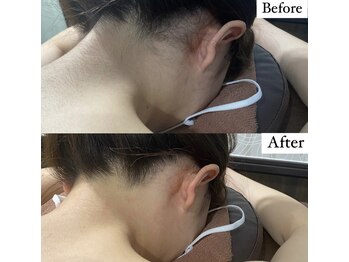 ビマナ 小岩店(NU美Mana)/【うなじ脱毛】