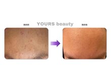 ユアーズ ビューティー(YOURS beauty)/棘あり☆１回
