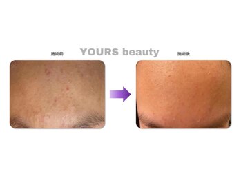 ユアーズ ビューティー(YOURS beauty)/棘あり☆１回