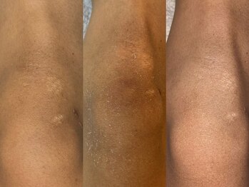 カリオン/ひじ、ひざの黒ずみ悩み改善