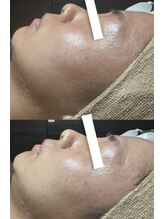 フィール(feel)/ビフォー　アフター　1回施術