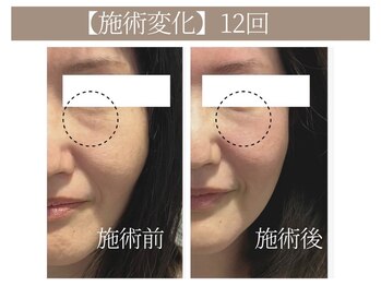 ドクターボディ 恵比寿店(Dr.Body)/【目の下のたるみ 40代】