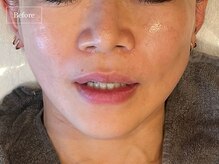 キュレイテッドスキン(CURATED SKIN)/ピーリング/毛穴ケア/肌質改善