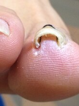 フットスタイル 八丁堀店(FOOT STYLE)/専門のプロによる巻爪矯正コース