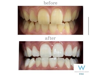 ホワイトニングショップ 新潟店/ホワイトニングビフォーアフター